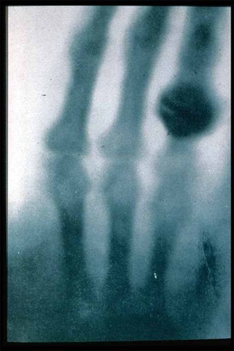 The first ever x-ray, taken by Wilhem Rontgen in 1895, of his wife's hand and wedding ring - HeadStuff.org