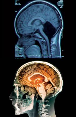 missing cerebellum, living without cerebellum, without part of the brain, how much of your brain do you use, do we need a brain, science, neuroscience, image, picture - HeadStuff.org