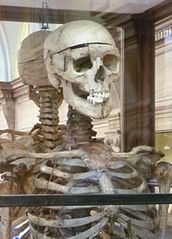 William Burke’s skeleton. - headstuff.org