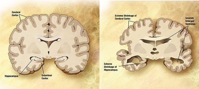 Alzheimer's Brain